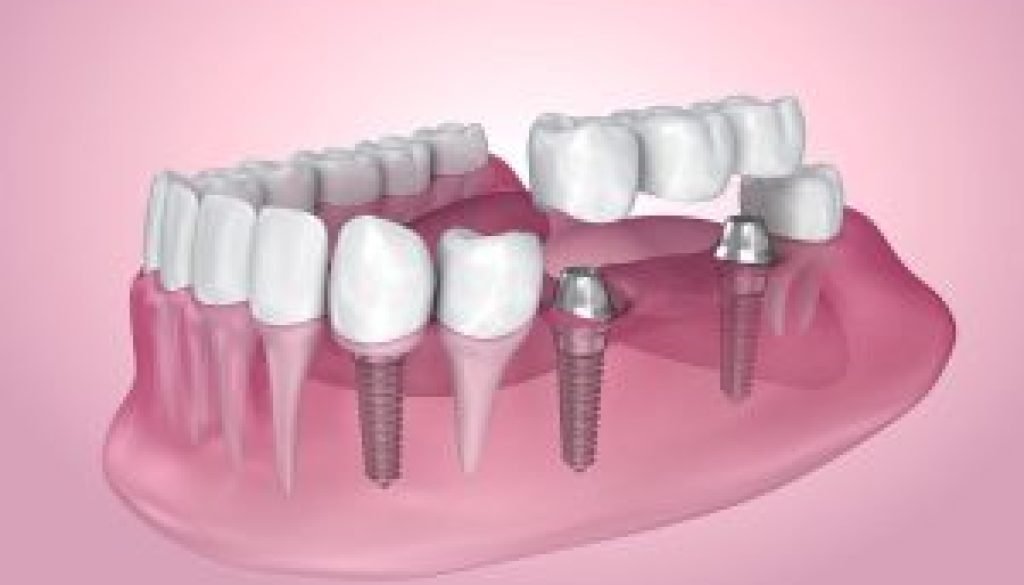 The Benefits of All on 4 Dental Implants