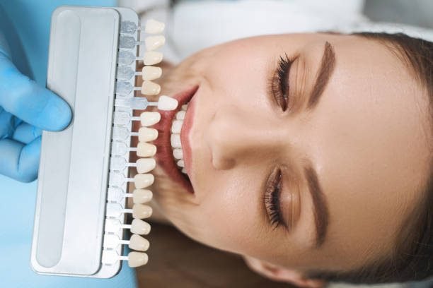 The Complete Guide To Dental Veneers Everything You Need To Know