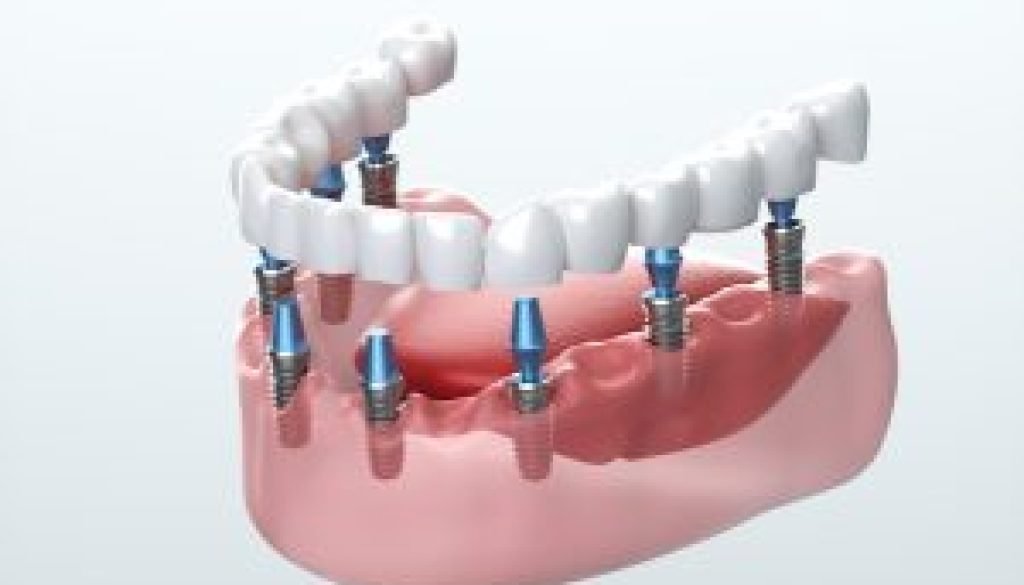 Barrow Dental Aesthetics Clinic: Restoring Your Smile with Dental Implants in Barrow-in-Furness