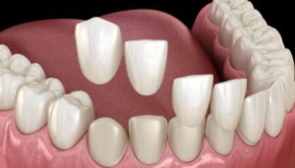 Composite Bonding vs. Porcelain Veneers: Which Is the Right Choice for You?