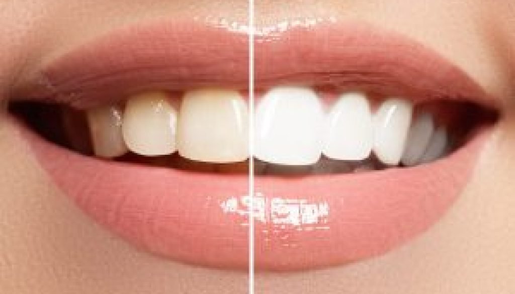 The Benefits of Teeth Whitening: Brighten Your Smile and Boost Your Confidence