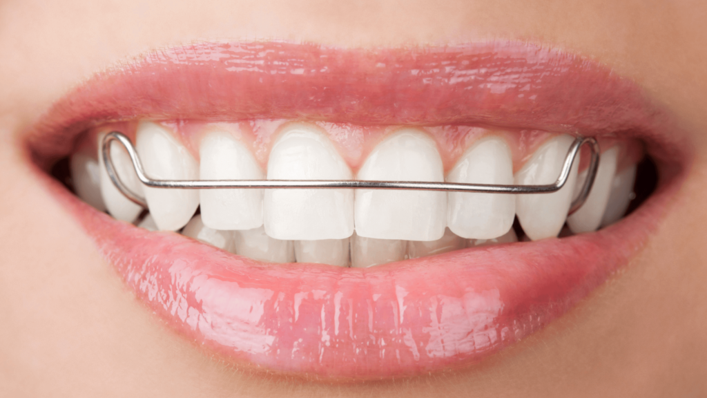 Invisalign