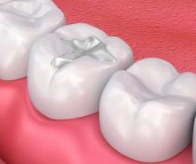 Are Composite Fillings Strong?