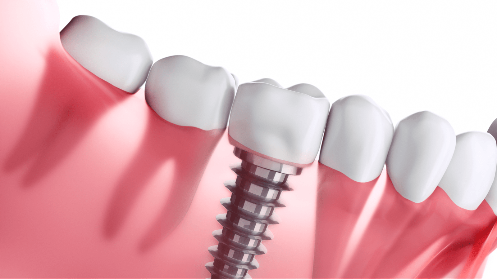 When is it Too Late to Get Dental Implants