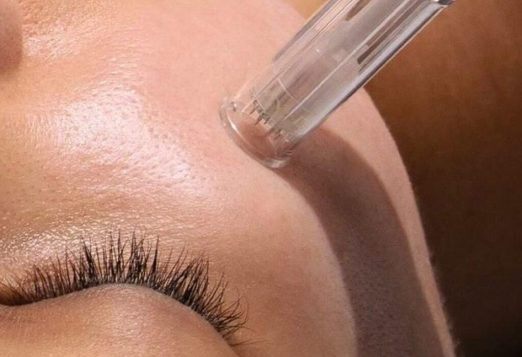 Close-up of microneedling procedure in Barrow-in-Furness