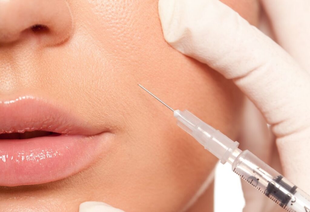 Close-up of nasolabial fold filler injection in Barrow-in-Furness
