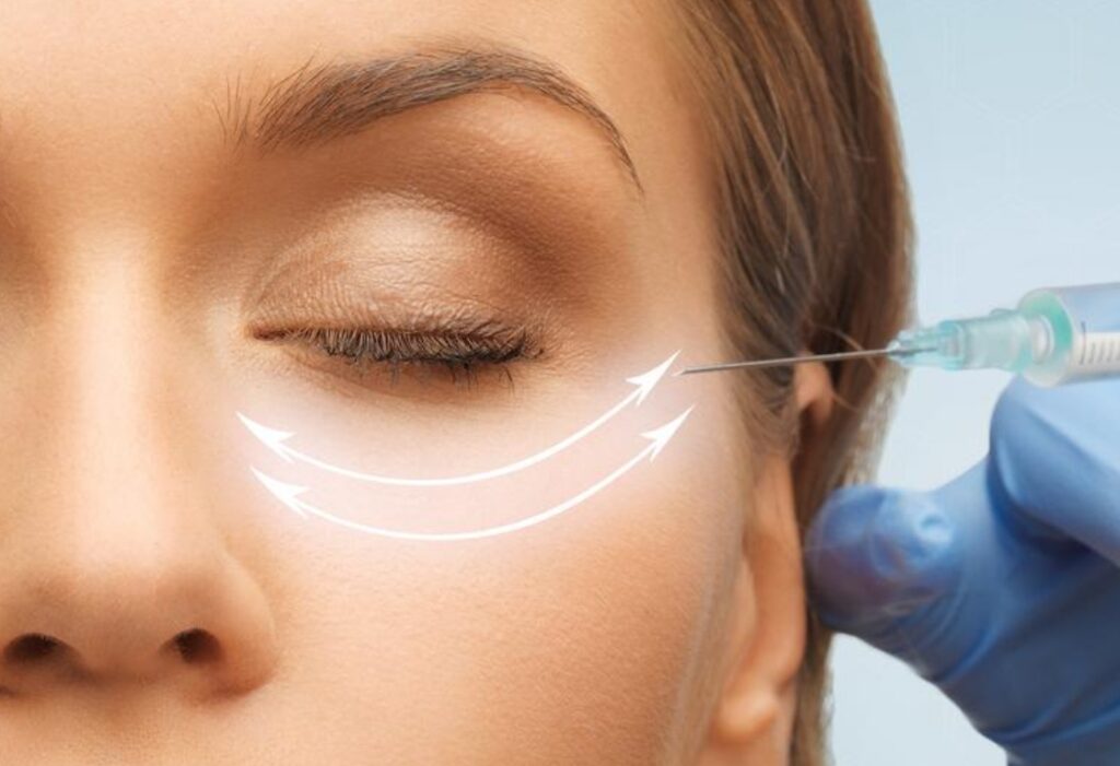 Close-up of under-eye filler injection in Barrow-in-Furness
