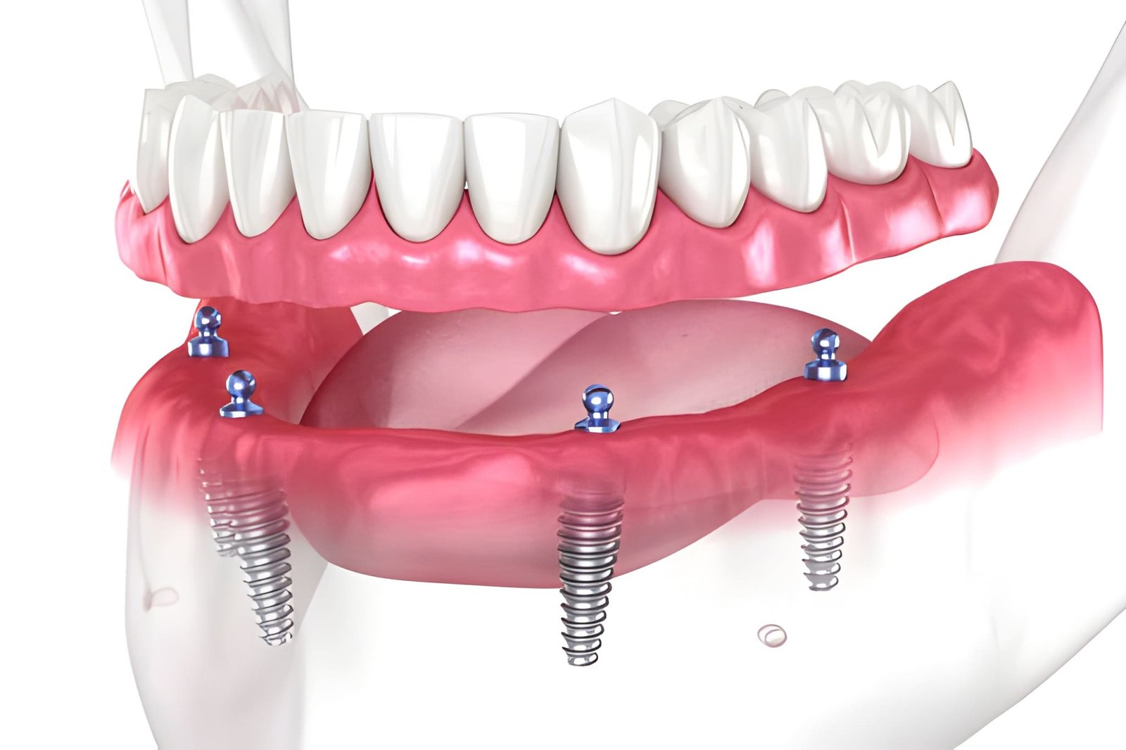 best denture treatment in Barrow in Furness